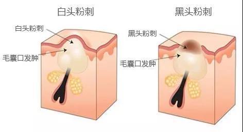 ʲô�Ƿ۴̣��۴�����ô�γɵ�