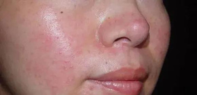 常见的面部皮炎种类有哪些