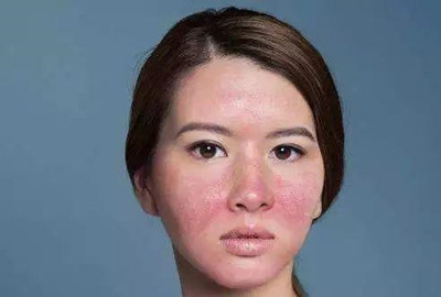 常见的面部皮炎种类有哪些