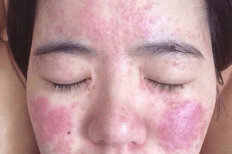 激素脸有哪些症状