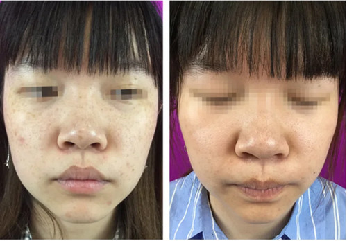 长春哪里治疗雀斑比较好