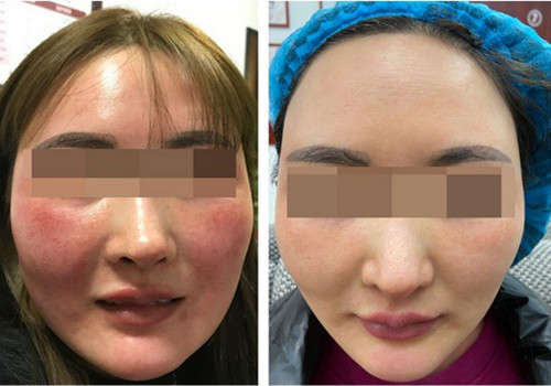 长春哪个医院看皮肤皮炎比较好