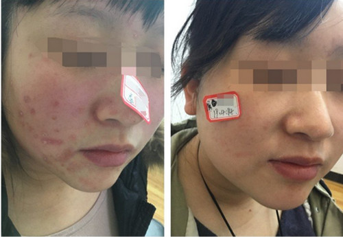 长春哪个医院看皮肤皮炎比较好