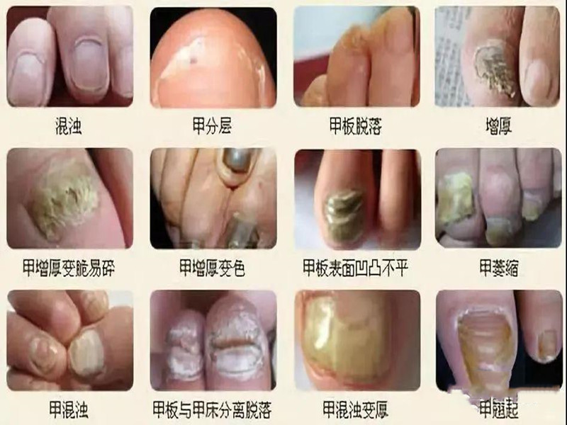 长春那个医院治疗灰指甲效果好?收费高吗