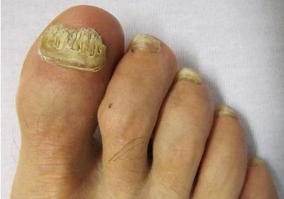 长春灰指甲去医院挂哪个科