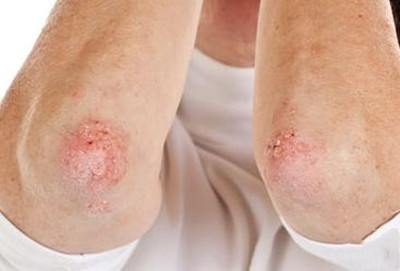 夏季牛皮癣患者要怎么护理皮肤