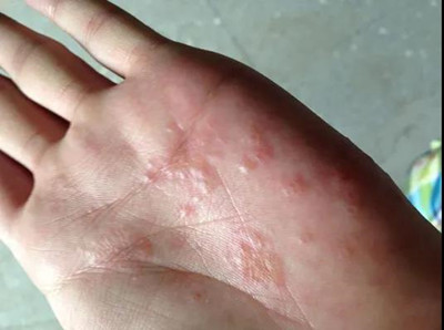 湿疹除了瘙痒还有哪些症状