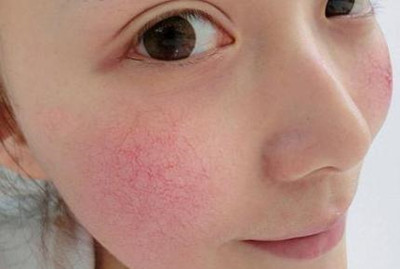 红血丝怎么治疗和修复