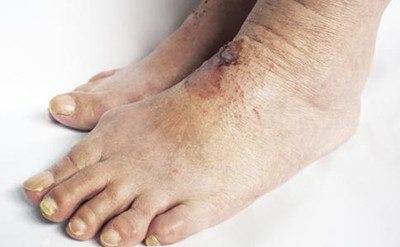 ������ʪ����ʲôҩ���