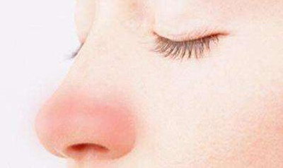 治酒糟鼻的最有效方法