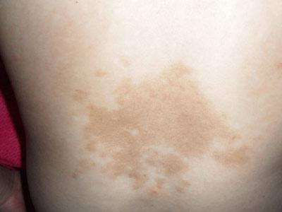 长春能否去除胎记