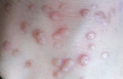 扁平疣是怎么引起的?怎么样治疗