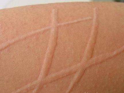 反复起荨麻疹用什么治好