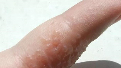 手上起小水泡很痒怎么回事
