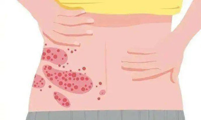 带状疱疹一般多长时间能治好