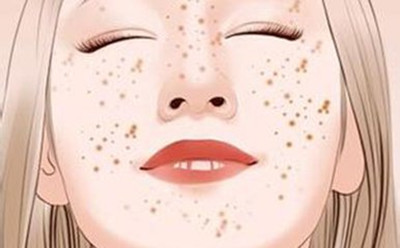 脸上的黄褐斑能去掉吗?