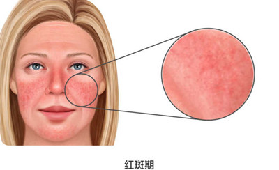 玫瑰痤疮是什么样子