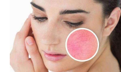 激光去除红血丝会复发吗