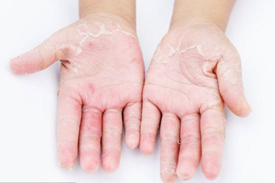 手上真菌感染要多久能好