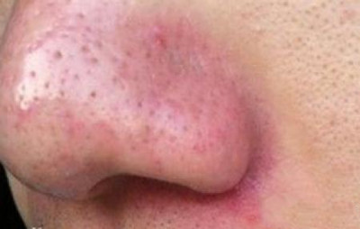 玫瑰痤疮是什么原因引起的