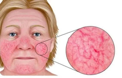 õ�����֢״��ͼƬ