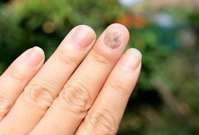 ָ�������Ⱦ��ʲôҩ���