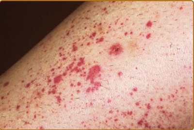 过敏性紫癜多久能消退