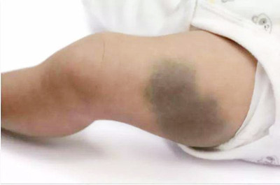 咖啡斑胎记能彻底去除吗