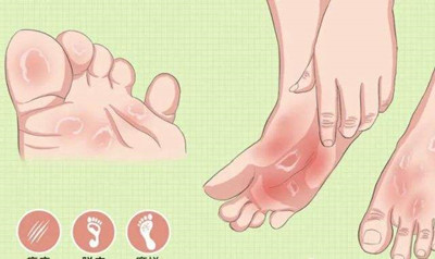 手足癣怎么治才能除根