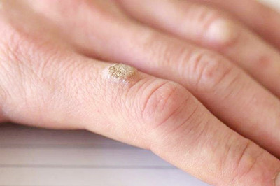 手上长的扁平疣怎么治