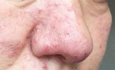 酒糟鼻子怎么治疗