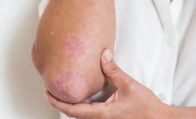 湿疹反反复复,揪出“凶手”是关键!