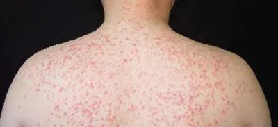 毛囊炎越来越严重?都是不重视惹的祸!