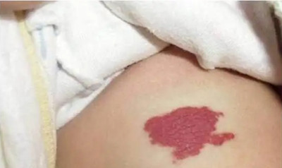 了解胎记的常见的4种类型,及时治疗很重要!