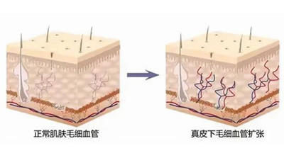 敏感性皮肤和皮肤过敏是一回事吗